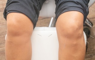 Acupuncture/Dry Needling on a knee