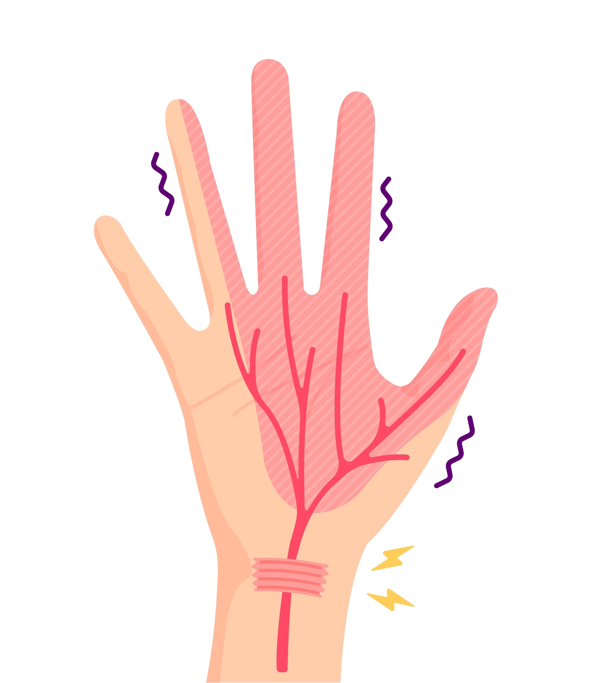 Carpal tunnel syndrome or referred neck pain/cervical nerve root compression?